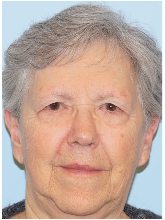 Endoscopic Browlift1* — Before