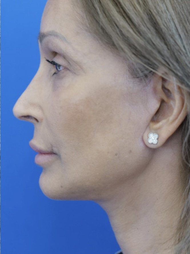 Face and Endobrow Lift — After