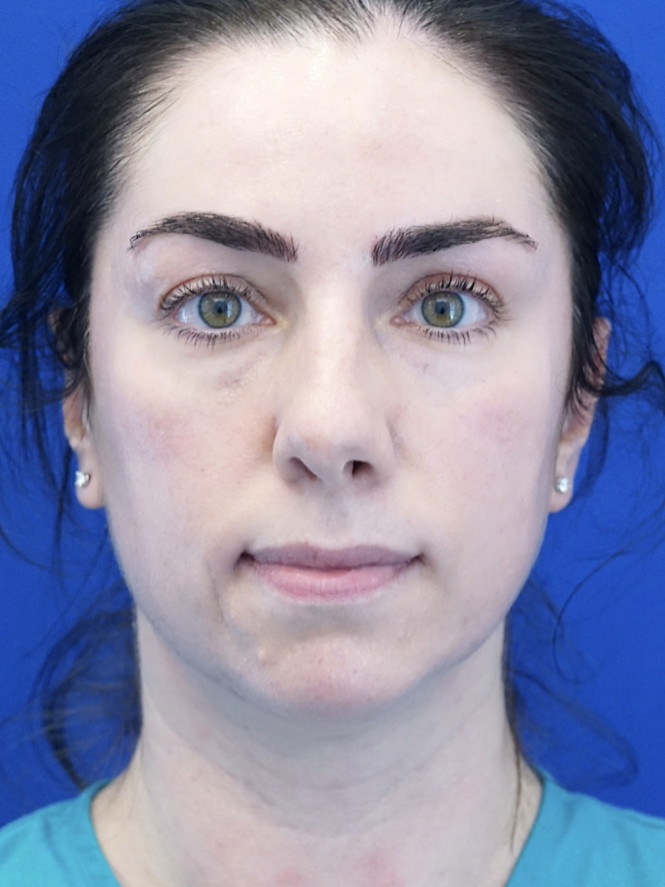 Tip Asymmetry — Before