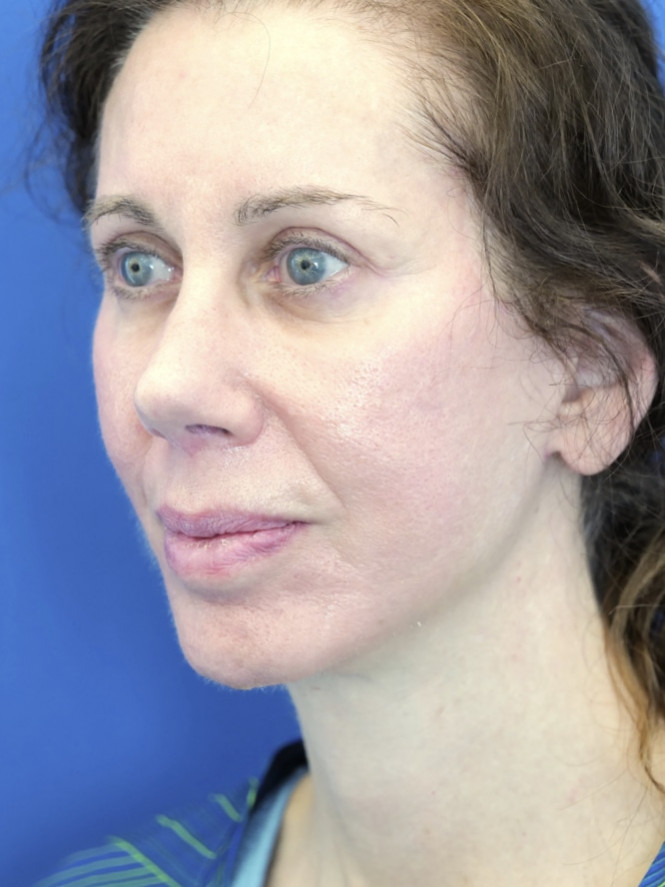 Natural Result — After