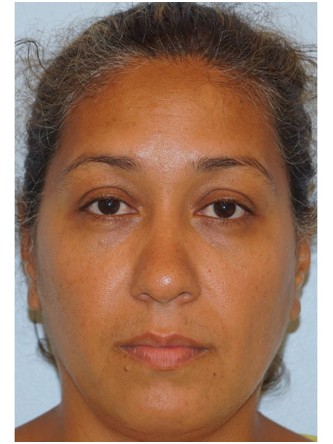 Lower Eyelid Excess Fat Pad3* — After