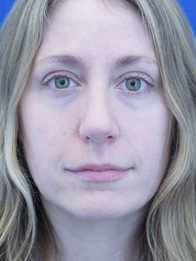 Nasal Profile Finesse — After