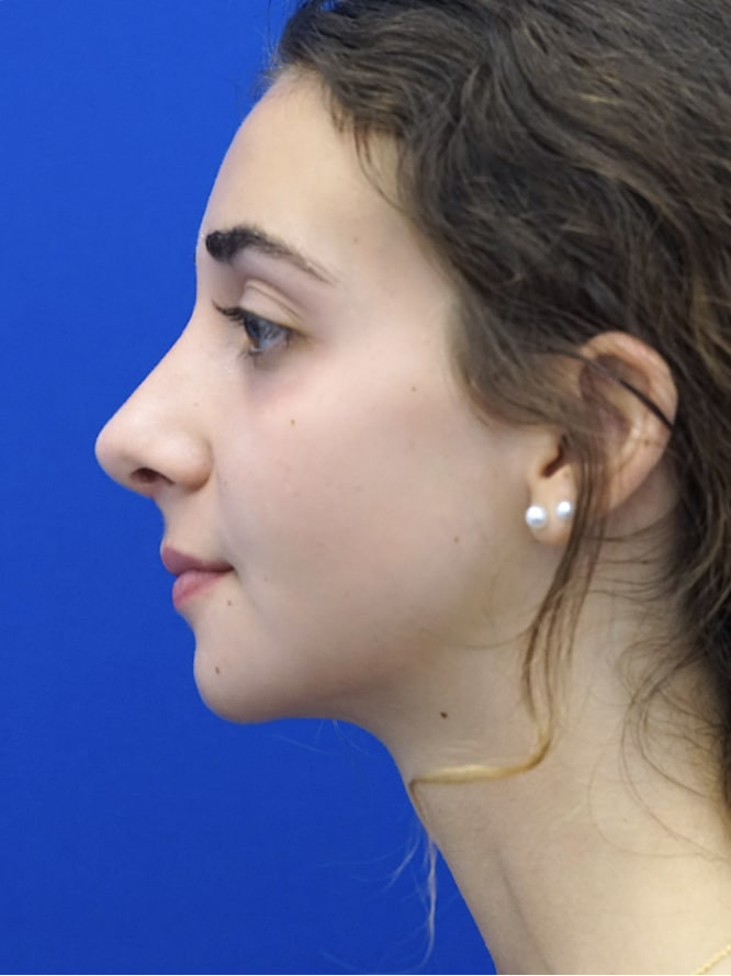 Classic Tension Nose — After