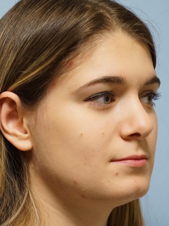 Droopy Tip Endonasal Rhinoplasty* — After