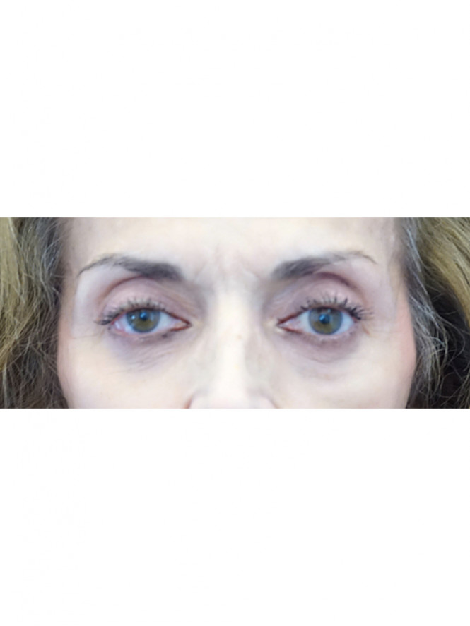 Quad Eyelid Rejuvenation — After