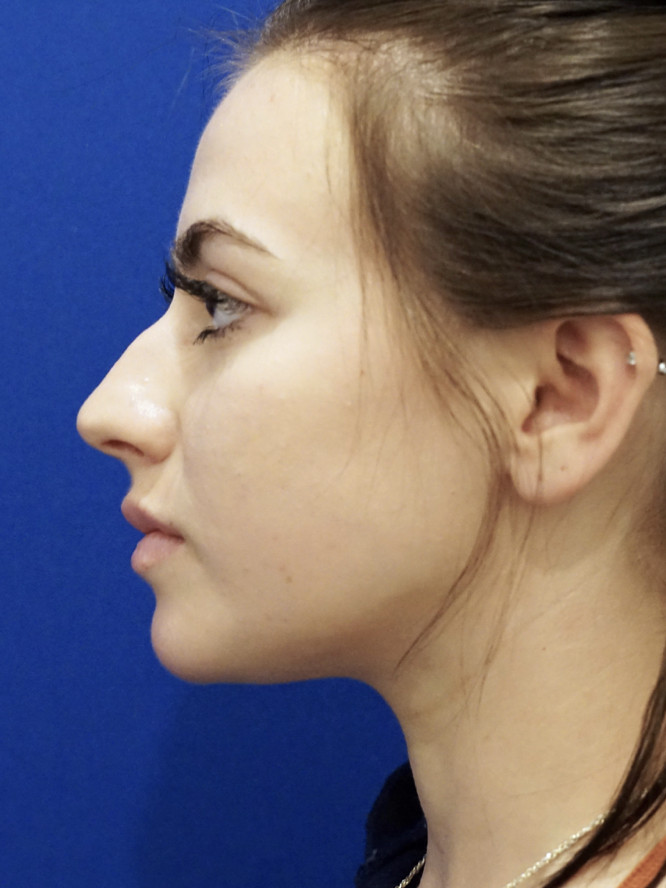 Smooth Dorsal Contour — Before
