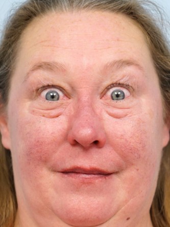 Upper and Lower Eyelid Blepharoplasty* — Before