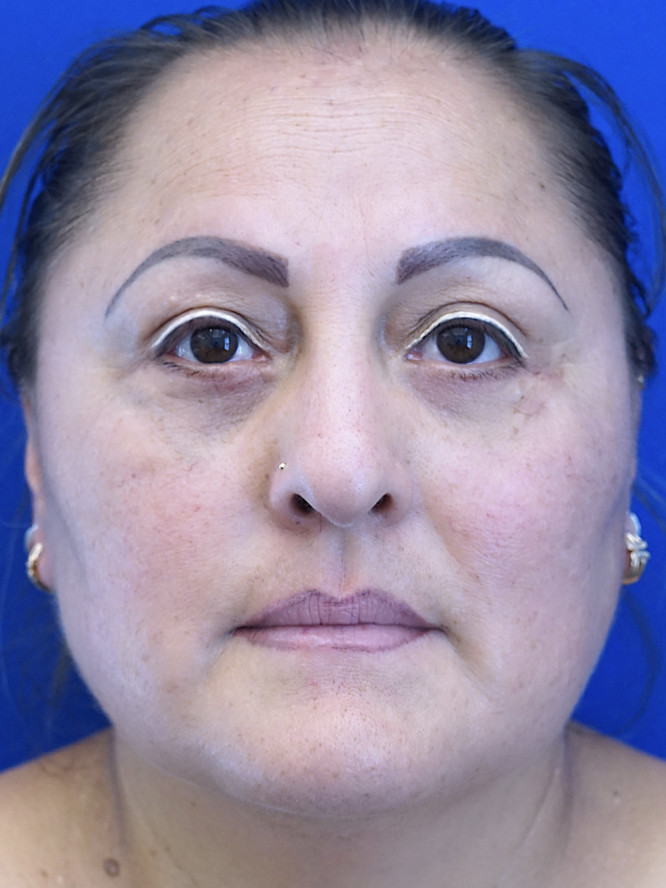 Lower Blepharoplasty Fat Reposition — After
