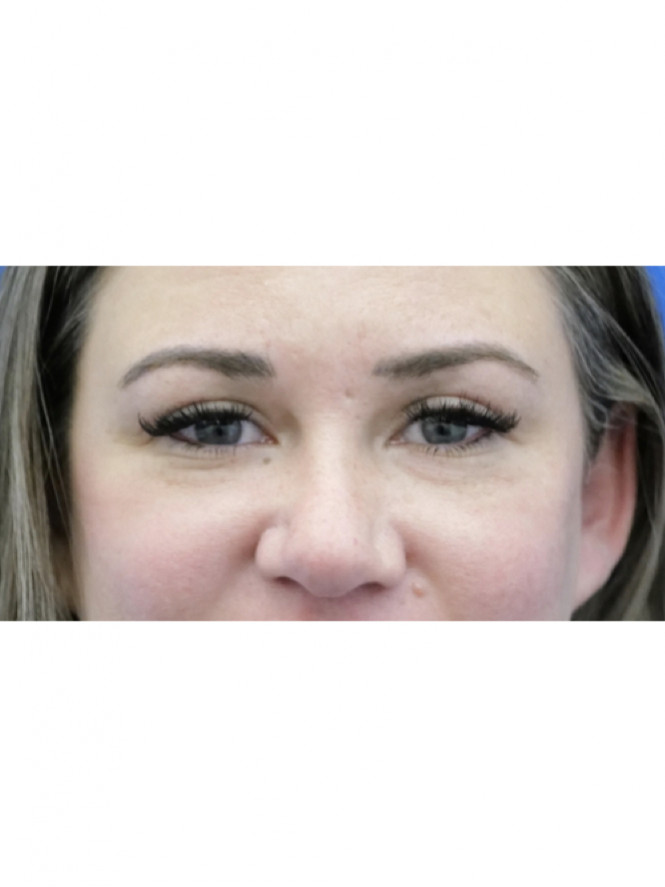 Upper Eyelid Crease Definition — After