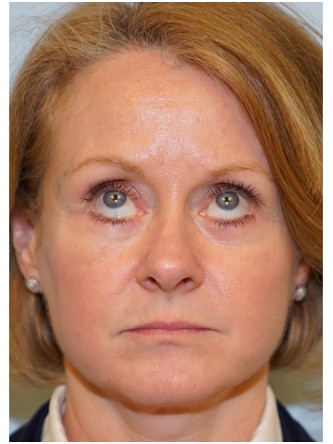 Lower Eyelid Excess Fat Pad1* — After