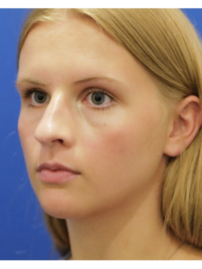 Soften Nasal Appearance — Before