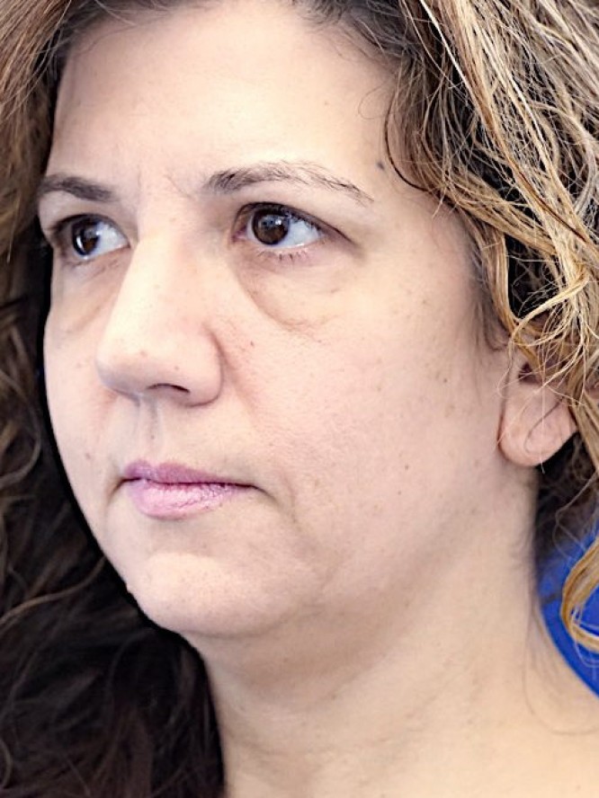 Deep Plane Face Lifting — Before