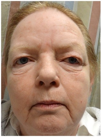 Visual Field Deficit – Eyelid Excess Skin4* — Before