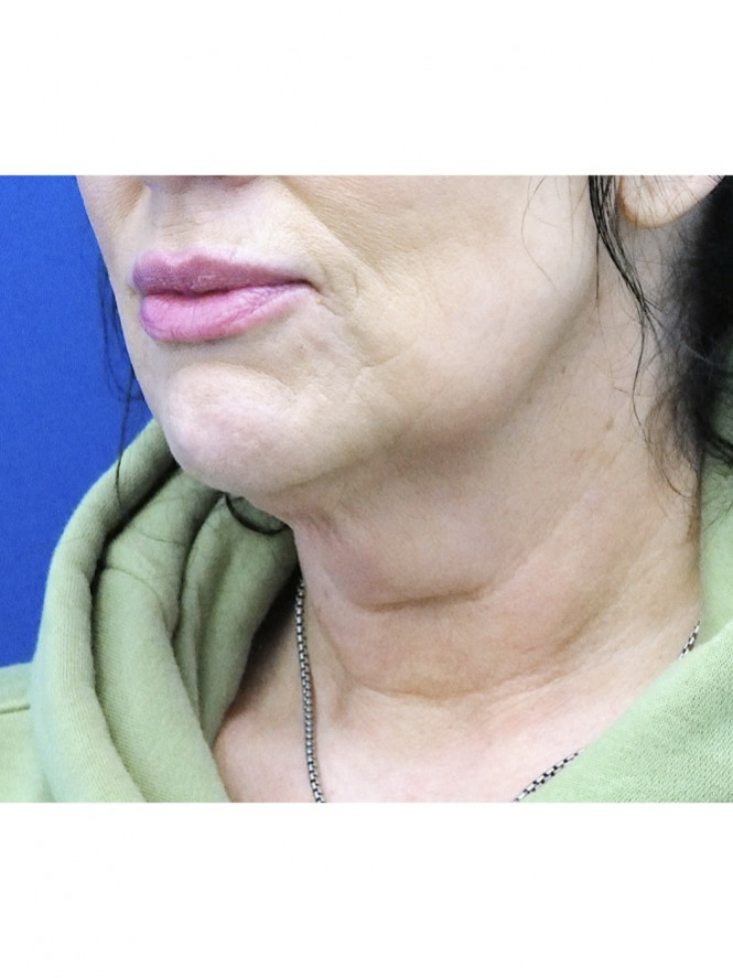 Case 6821: before Deep Plane Lower Facelift