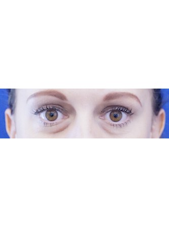 Lower Eyelid Hollow* — Before