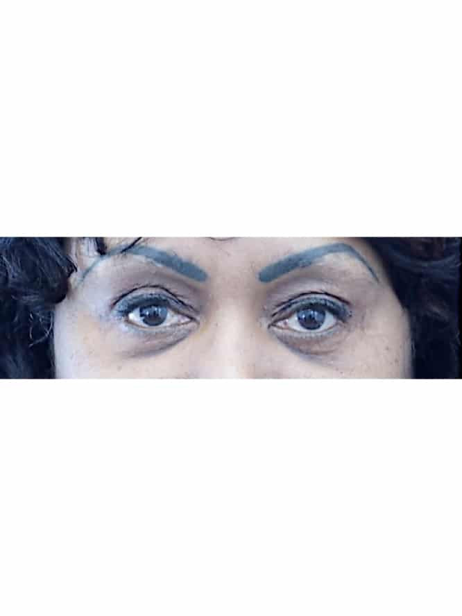 Quad Blepharoplasty Skin Only with Fat Grafting — Before