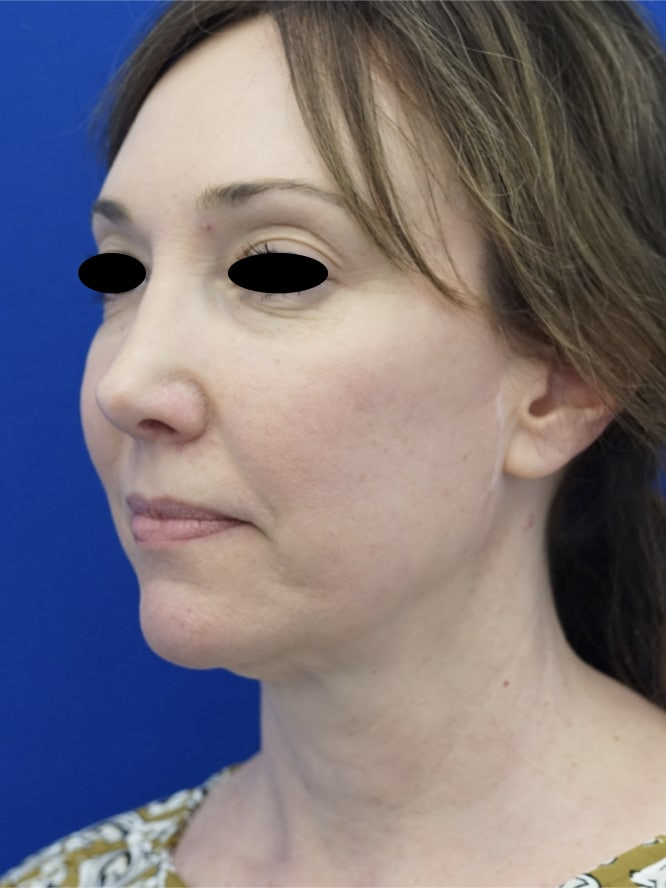 Secondary Deep Plane Lift with Scar Revision — Before