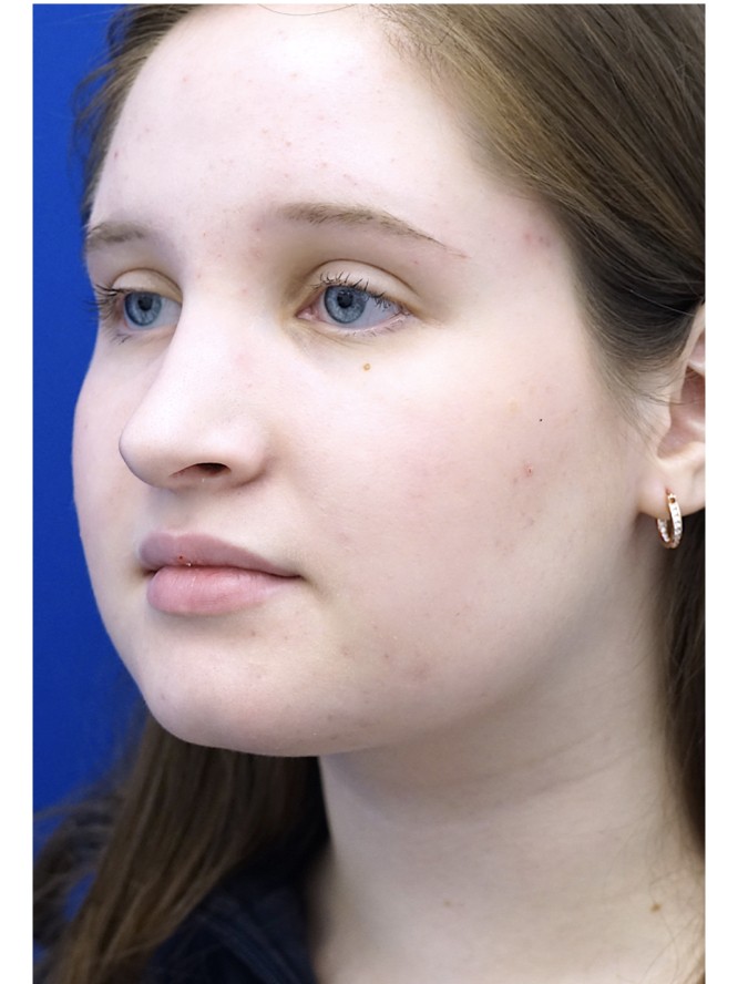 Reduction Dorsal Hump — After