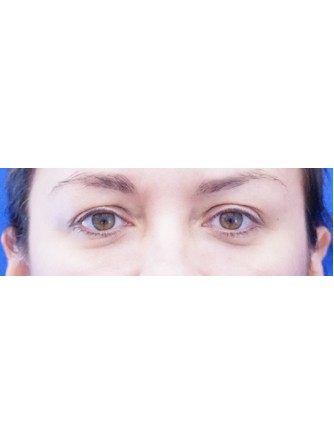 Tear Trough Fillers* — After