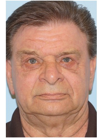 Upper Eyelid Droop and Excess Skin* — After