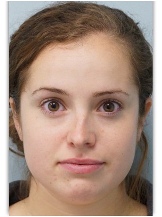Crooked Nose Endonasal Technique1* — Before
