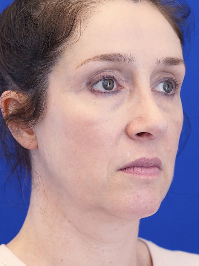 Nasal Aesthetic Nuances — After