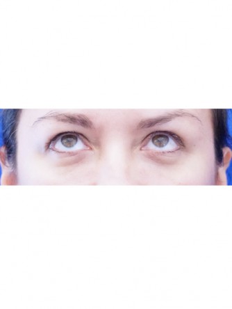 Tear Trough Fillers* — After