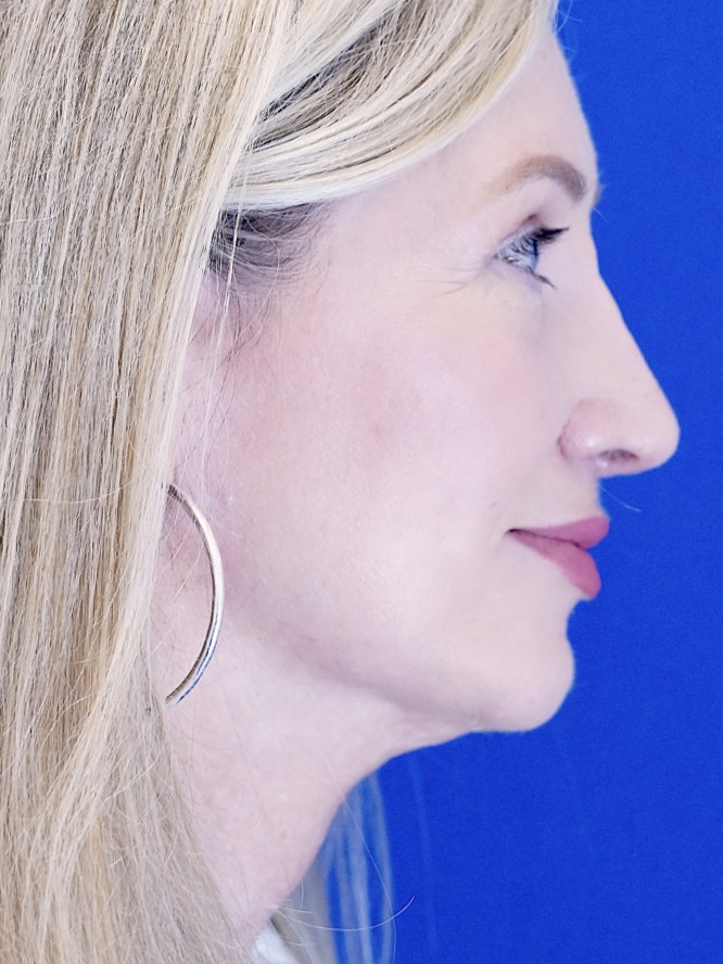 Thick Skin Droopy Nose — After