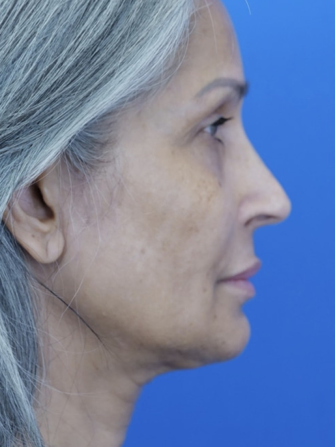 Face and Endobrow Lift — Before