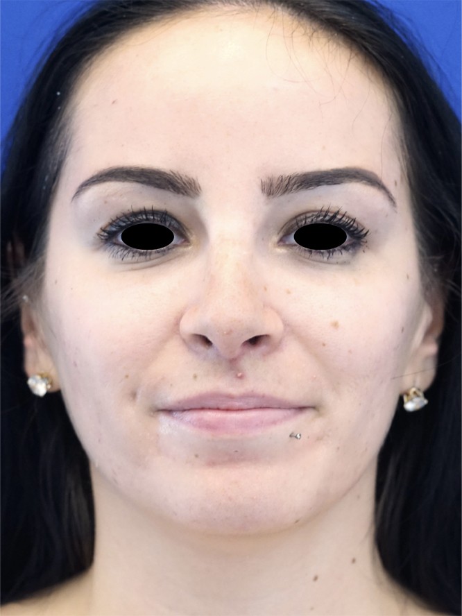 Nasal Tip Refinement — After