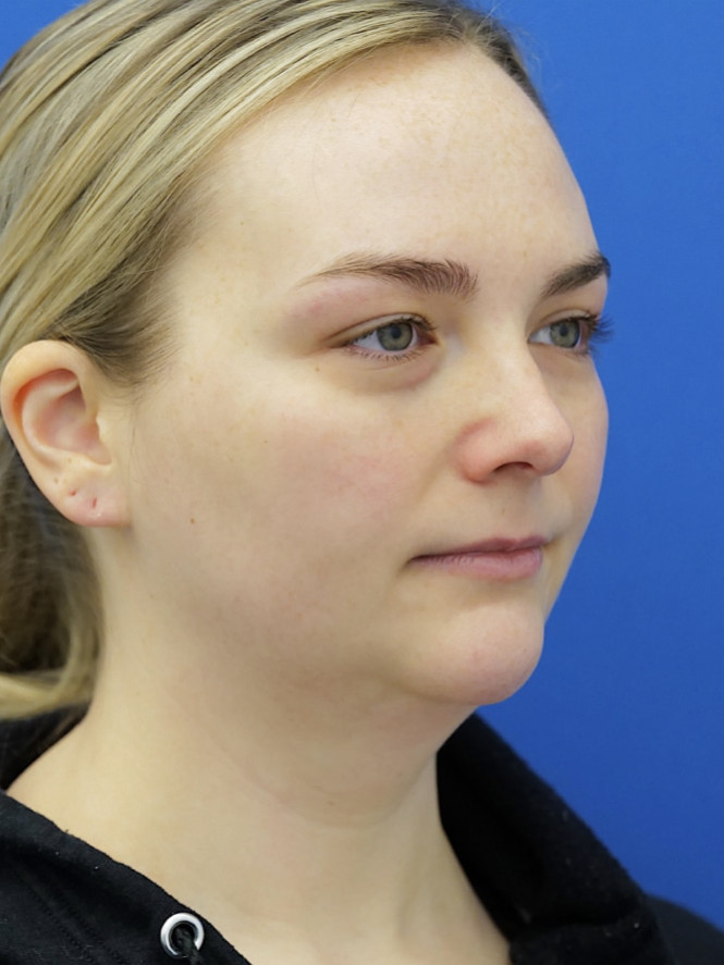 Case 7154: before Natural Result