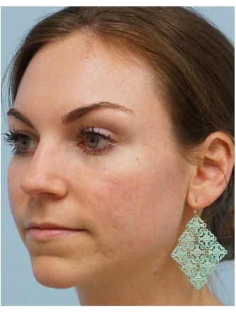 Fractional CO2 Laser Skin Resurfacing1* — After
