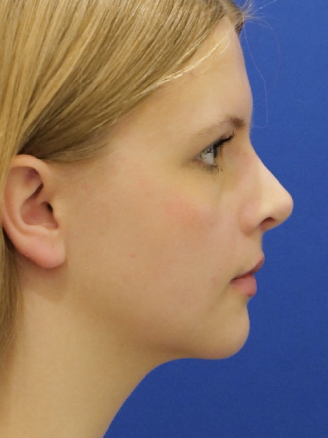 Soften Nasal Appearance — After