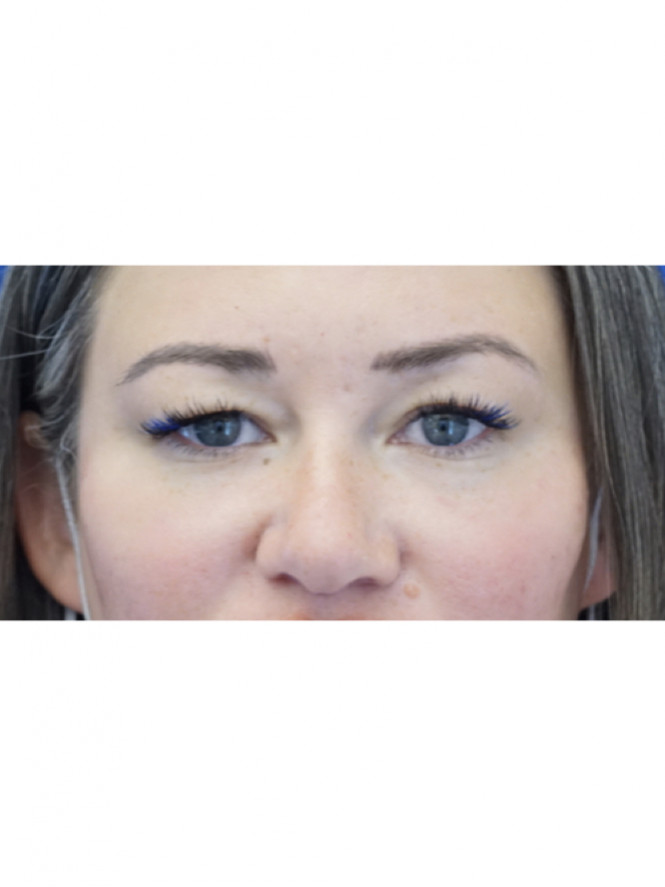 Upper Eyelid Crease Definition — Before
