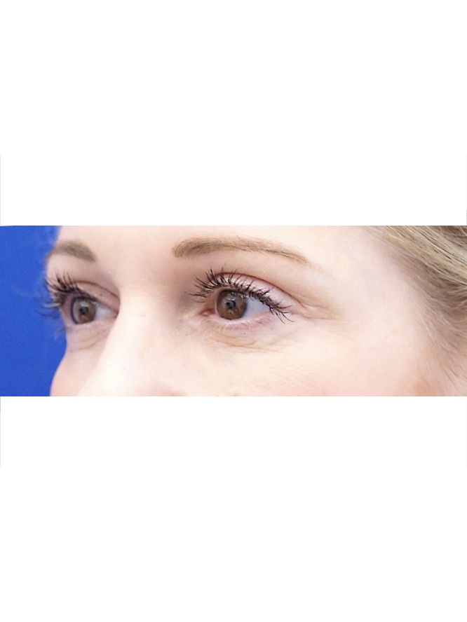 Lower Blepharoplasty and Fat Grafting — Before