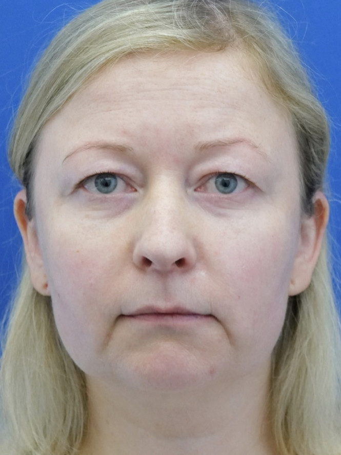 Eyelid Lift and Brow Fat Suspension — Before