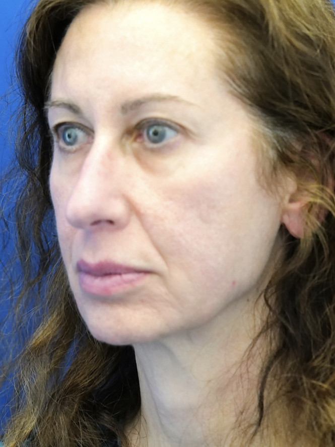 Natural Result — Before