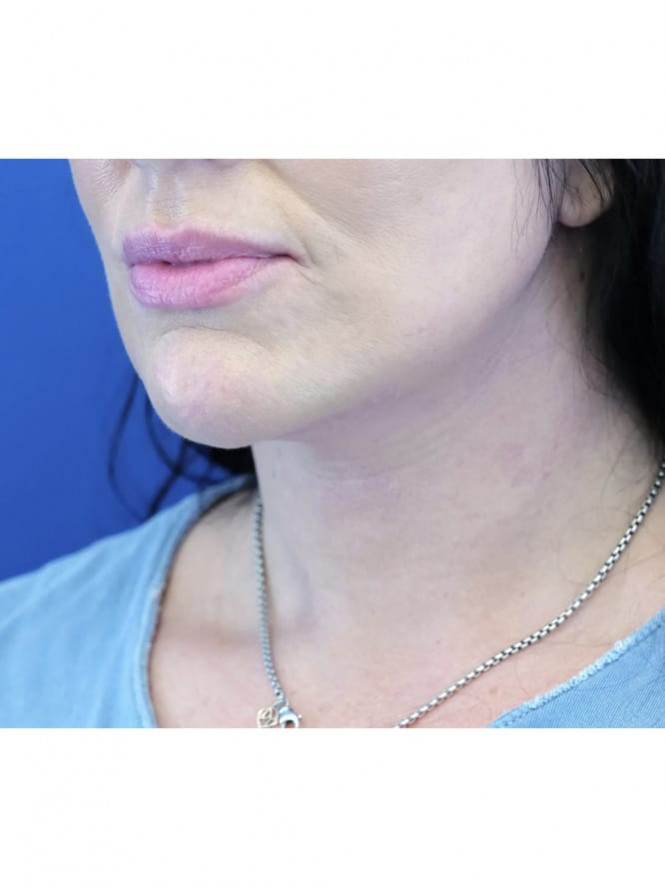 Case 6821: after Deep Plane Lower Facelift