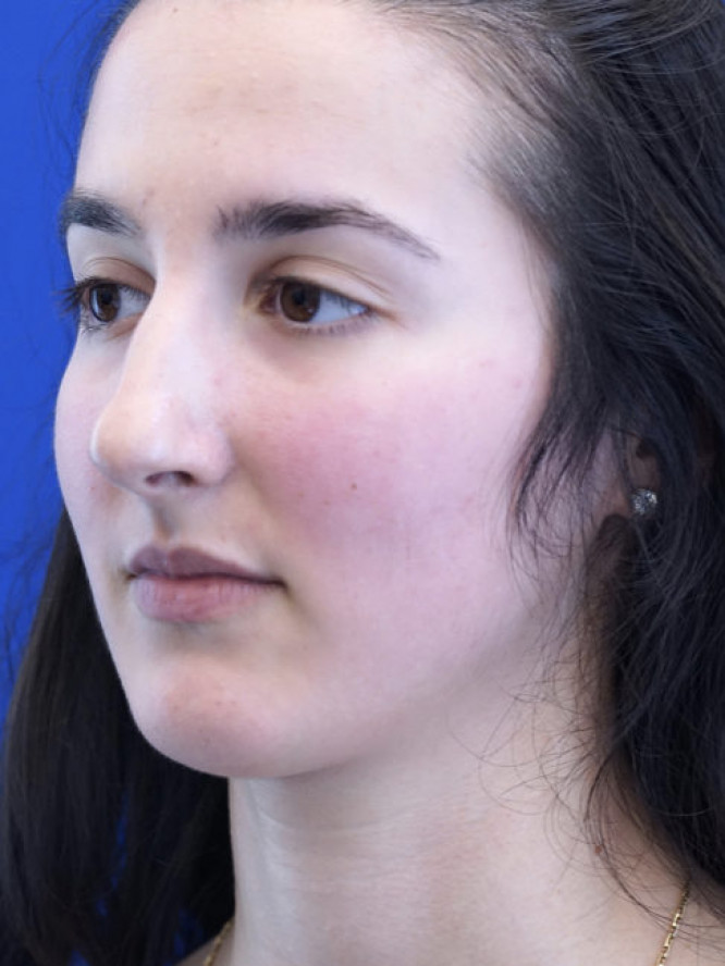 Endonasal Finesse Rhinoplasty — Before