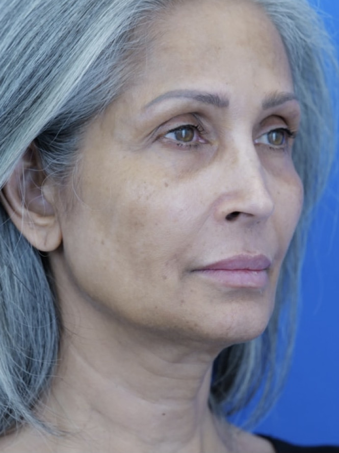 Face and Endobrow Lift — Before