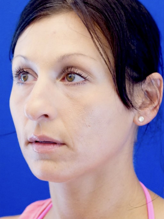 Downturn Tip Endonasal Rhinoplasty — Before