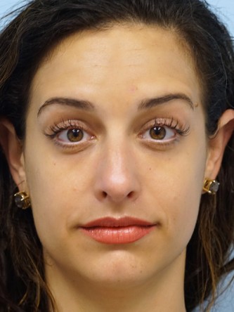 Lower Eyelid Dark Shadow* — After