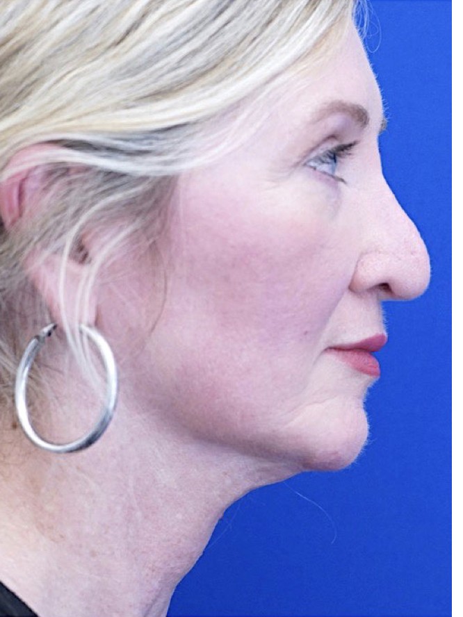 Thick Skin Droopy Nose — Before