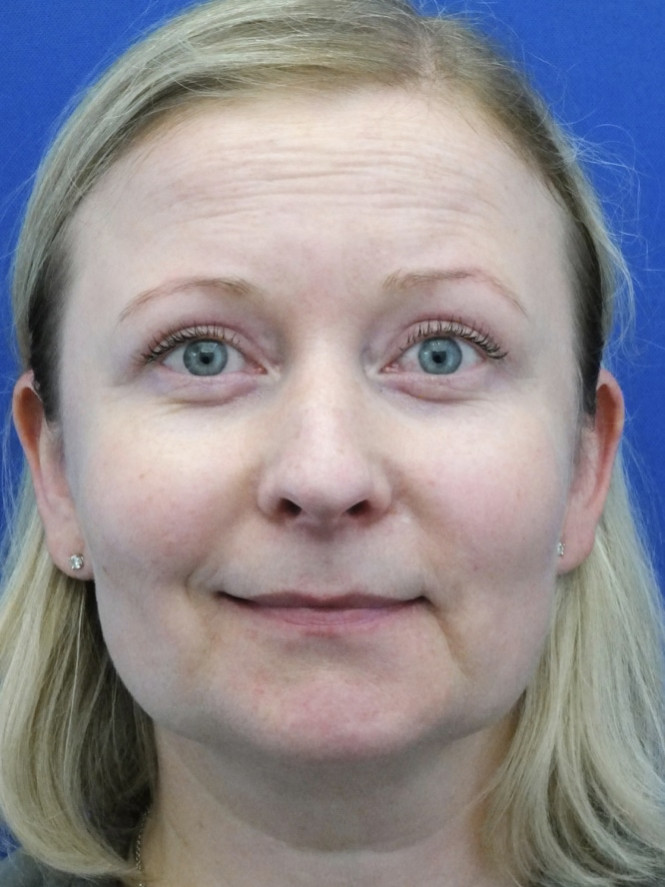 Eyelid Lift and Brow Fat Suspension — After