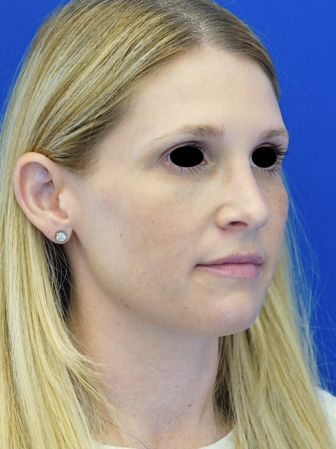 Scarless Hump Removal — After