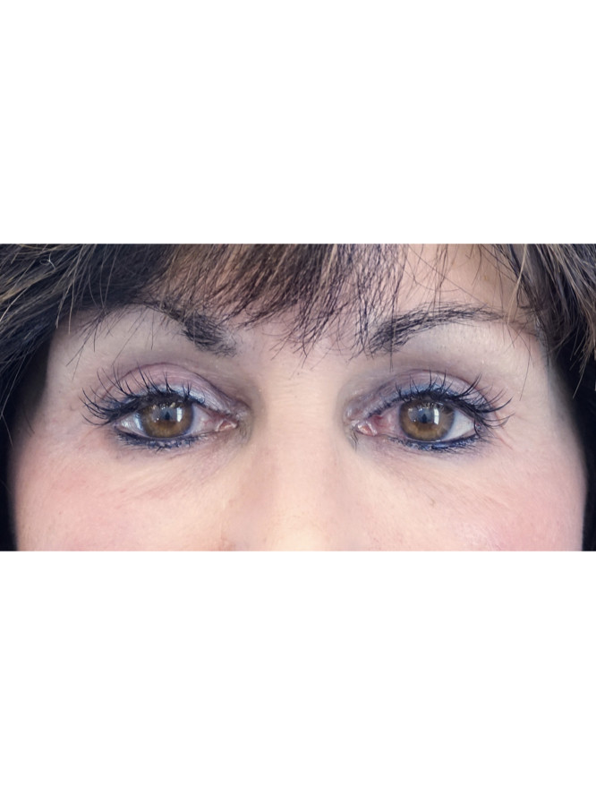 Refresh Upper Eyelid Fold — After