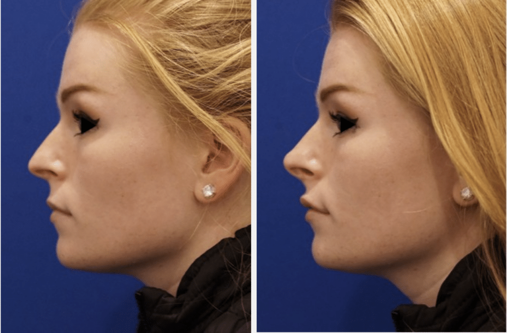 Liquid Rhinoplasty Before & After