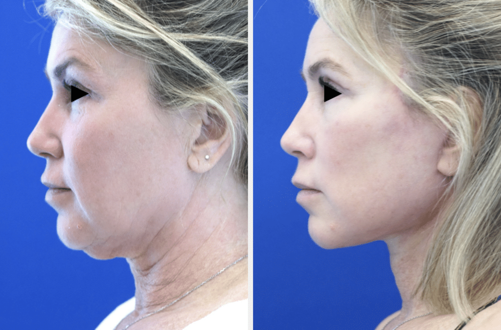 height subliminal results before and after