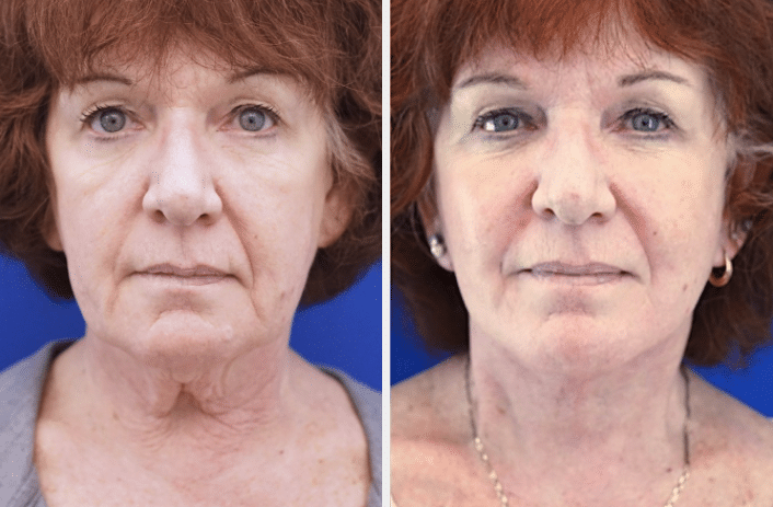 A before and after image of a mature woman with loose neck skin that underwent a neck lift procedure.