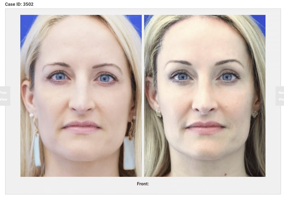 Brow Lift Bef Aft